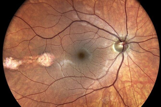 Οφθαλμολογική Απεικόνιση Υπερ-Ευρέως Πεδίου