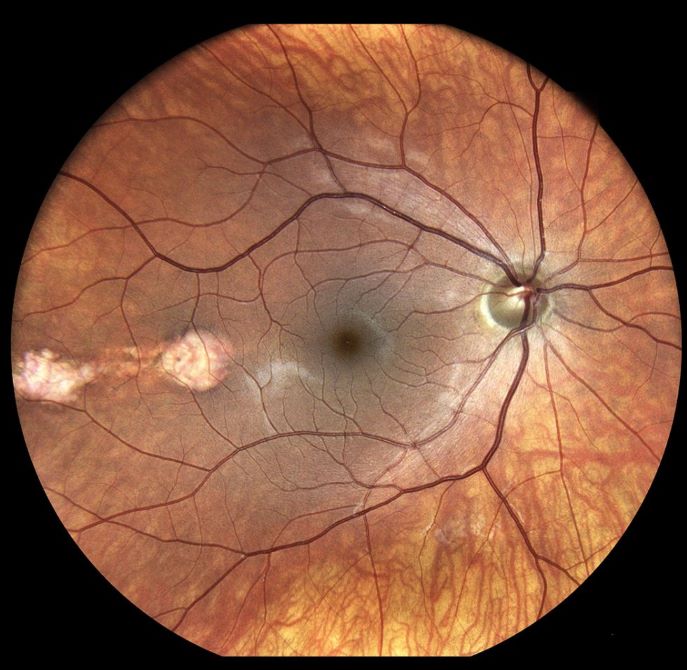 Έγχρωμη απεικόνιση υπερ-ευρέως πεδίου βυθού οφθαλμού που αναδεικνύει τον αμφιβληστροειδή, την ωχρά κηλίδα και το αγγειακό δίκτυο.